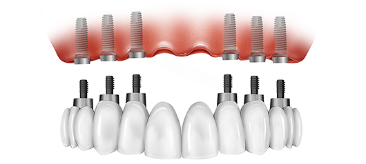 all-on-six-implant