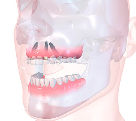 implant dentar rapid pret - clinica stomatologica Dentocalm Cluj