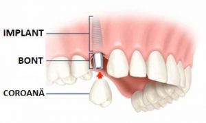 implant-dentar-bont-coroana