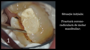 fractura corono-radiculara molar mandibilar