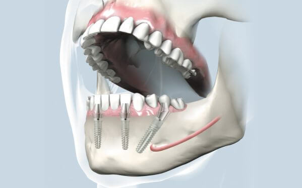 implanturi dentare fast and fixed - implantologie Cluj @ Dentocalm