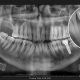 implanturi dentare cluj, avantaje implante - stomatologie Cluj, clinica dentara Dentocalm