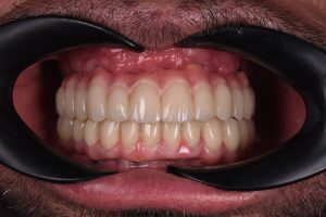 reabilitare totala Cluj - implanturi dentare fast and fixed - clinica stomatologica Dentocalm