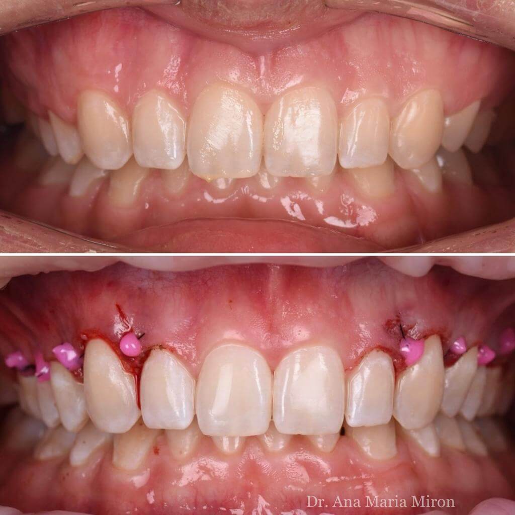 tratament suras gingival - estetica dentara, clincia stomatologica Dentocalm