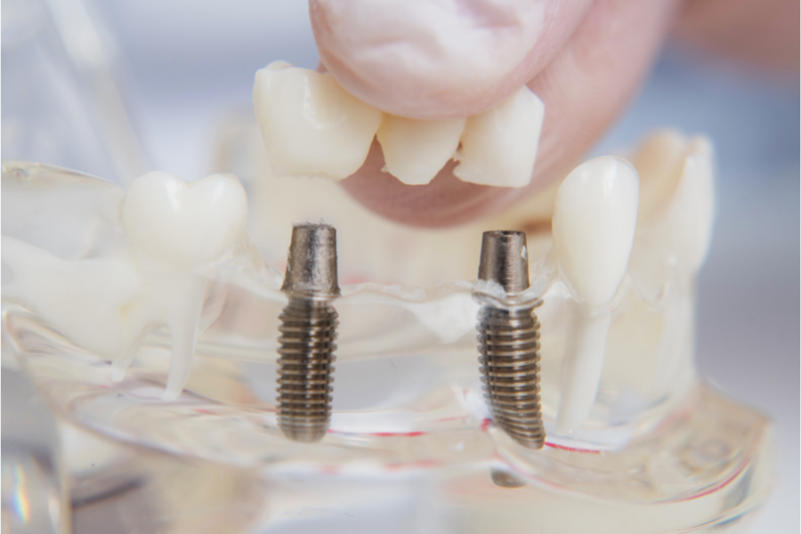 implanturi dentare Cluj - implantologie Cluj