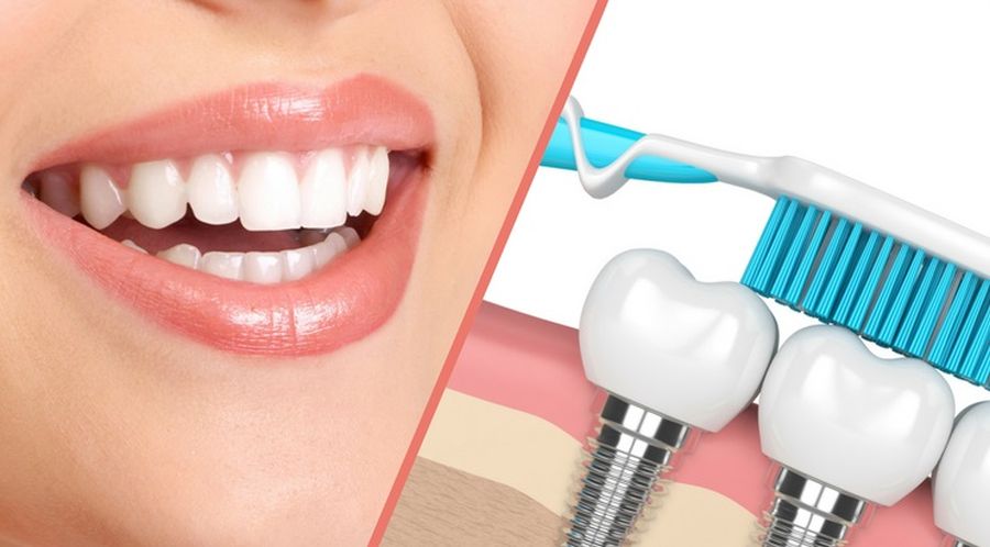 implant dentar Cluj