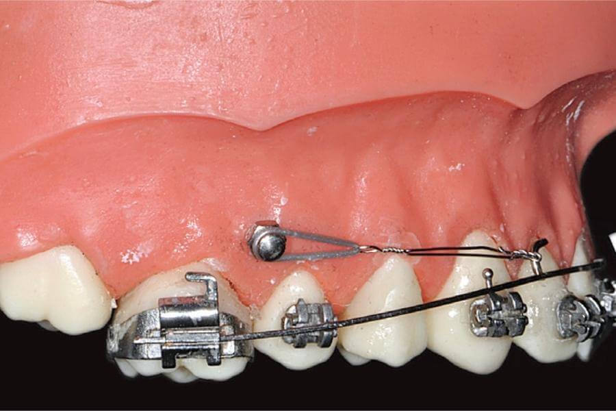 mini implant ortodontic - aparate dentare Cluj