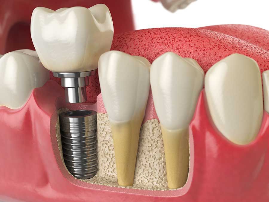 implant dentar in Cluj la clinica DentoCalm