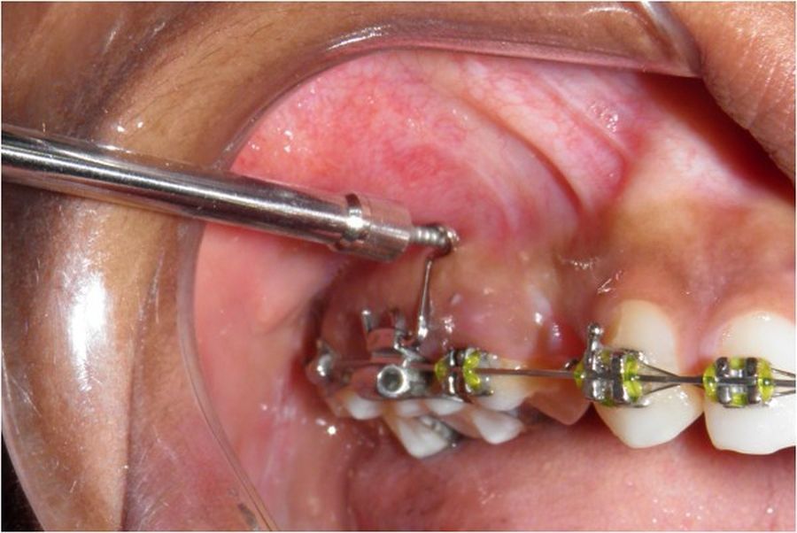 aparate dentare Cluj, tratament ortodontic
