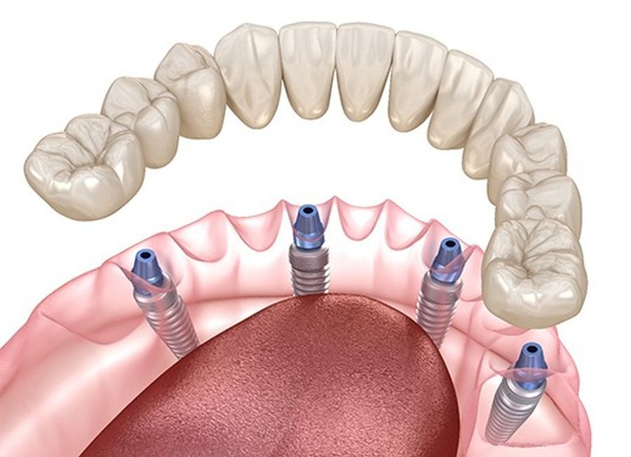 implant dentar Cluj, clinica implantologie Cluj-Napoca