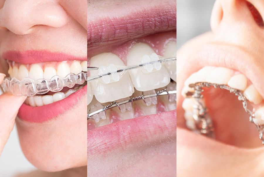 aparate dentare copii Cluj, ortodontie Cluj, tratament ortodontic cu aparat dentar safir