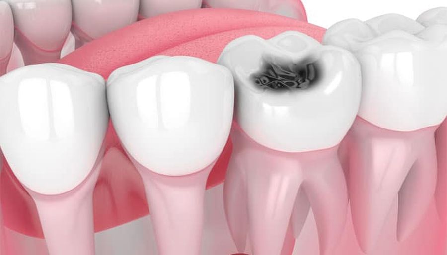 tratamente dentare Cluj, tratament carii dentare, implant dentar, chirurgie orala