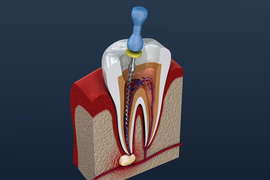 tratament endodontic Cluj, endodontie, tratament de canal